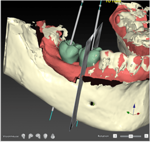Cycle Initial en Implantologie Chirurgicale et Prothetique (1)