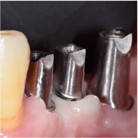 Cycle Initial en Implantologie Chirurgicale et Prothetique (12)