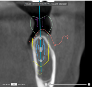 Cycle Initial en Implantologie Chirurgicale et Prothetique (2)