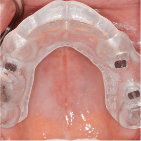 Cycle Initial en Implantologie Chirurgicale et Prothetique (3)