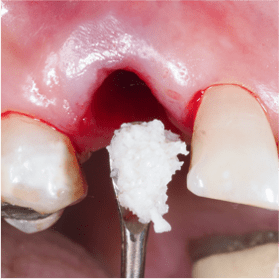 Cycle Initial en Implantologie Chirurgicale et Prothetique (6)