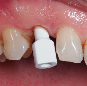 Cycle Initial en Implantologie Chirurgicale et Prothetique (8)