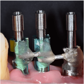 Cycle Initial en Implantologie Chirurgicale et Prothetique (9)