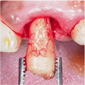 Formation Extraction Implantation IFIP (1)