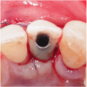 Formation Extraction Implantation IFIP (10)
