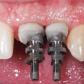 Formation Extraction Implantation IFIP (12)
