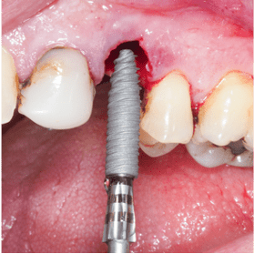 Formation Extraction Implantation IFIP (2)