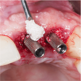 Formation Extraction Implantation IFIP (3)