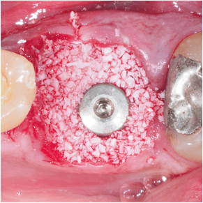 Formation Extraction Implantation IFIP (4)