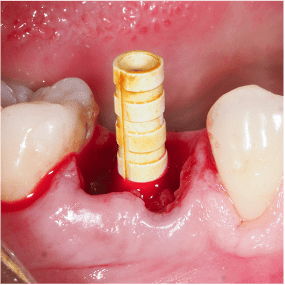Formation Extraction Implantation IFIP (5)