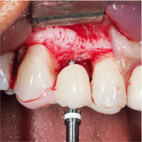 Formation Extraction Implantation IFIP (6)