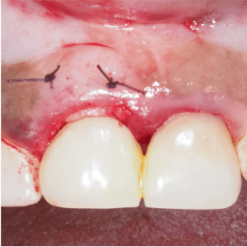 Formation Extraction Implantation IFIP (8)