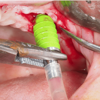 Formation IFIP comblements sinusiens Summers et Voie Laterale (10)