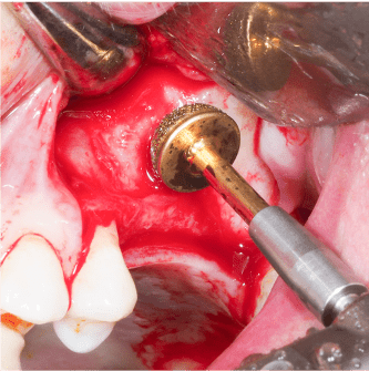 Formation IFIP comblements sinusiens Summers et Voie Laterale (2)