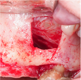 Formation IFIP comblements sinusiens Summers et Voie Laterale (3)