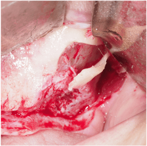 Formation IFIP comblements sinusiens Summers et Voie Laterale (4)