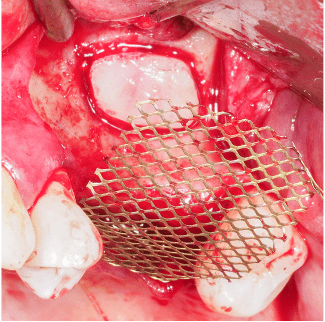 Formation IFIP comblements sinusiens Summers et Voie Laterale (5)