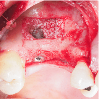 Formation IFIP comblements sinusiens Summers et Voie Laterale (6)