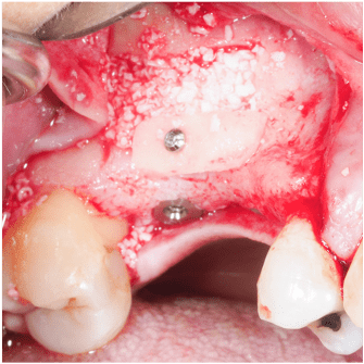 Formation IFIP comblements sinusiens Summers et Voie Laterale (7)