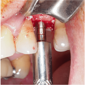 Formation IFIP comblements sinusiens Summers et Voie Laterale (9)