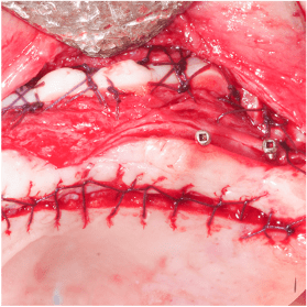 Formation IFIP tissus mous peri-implantaires (1)