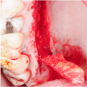 Formation IFIP tissus mous peri-implantaires (3)