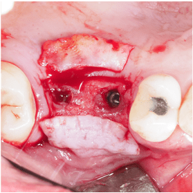 Formation IFIP tissus mous peri-implantaires (6)