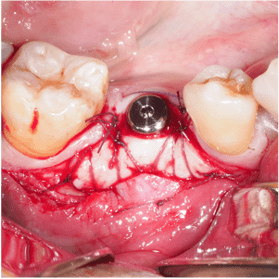 Formation IFIP tissus mous peri-implantaires (7)