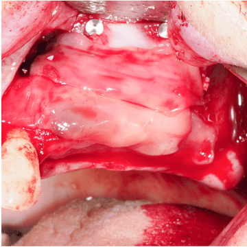 Formation Regenerations Osseuses Guidees IFIP (10)