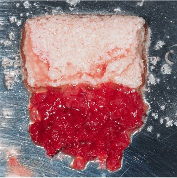 Formation Regenerations Osseuses Guidees IFIP (5)