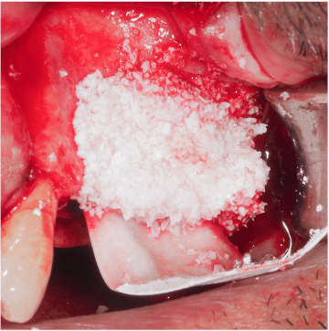 Formation Regenerations Osseuses Guidees IFIP (7)