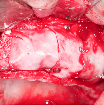 Formation Regenerations Osseuses Guidees IFIP (9)