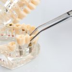 Extraction implantation immédiate - Mise en esthétique immédiate: qu’est-ce que l’extraction et la pose immédiate d’implant ?