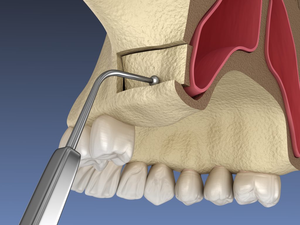 Formation Sinus Lift : Chirurgiens-dentistes, pourquoi se former à l’élévation sinusienne est essentiel ?
