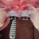 Pourquoi se former à l’implantologie en 2026 ?